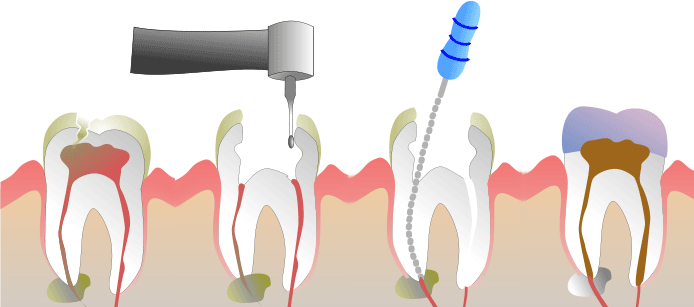 Despre hipodontie