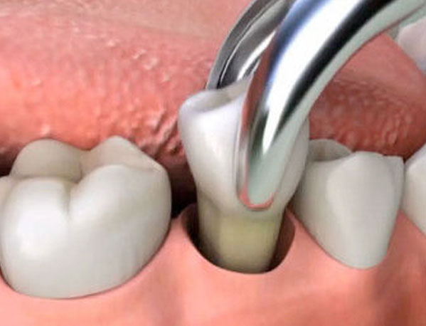 Cand poate fi necesara extractia unui dinte