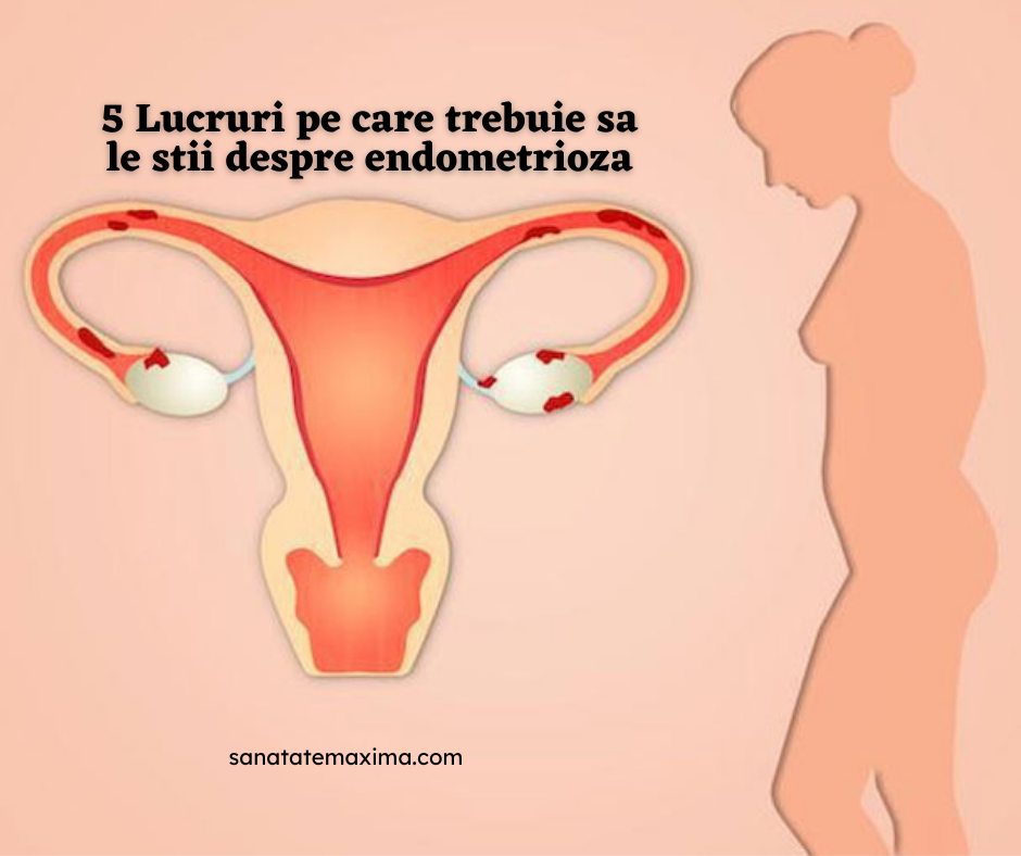 5 Lucruri pe care trebuie sa le stii despre endometrioza